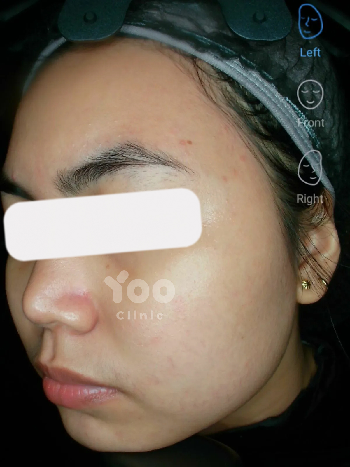 Acne Protocol Renewal after