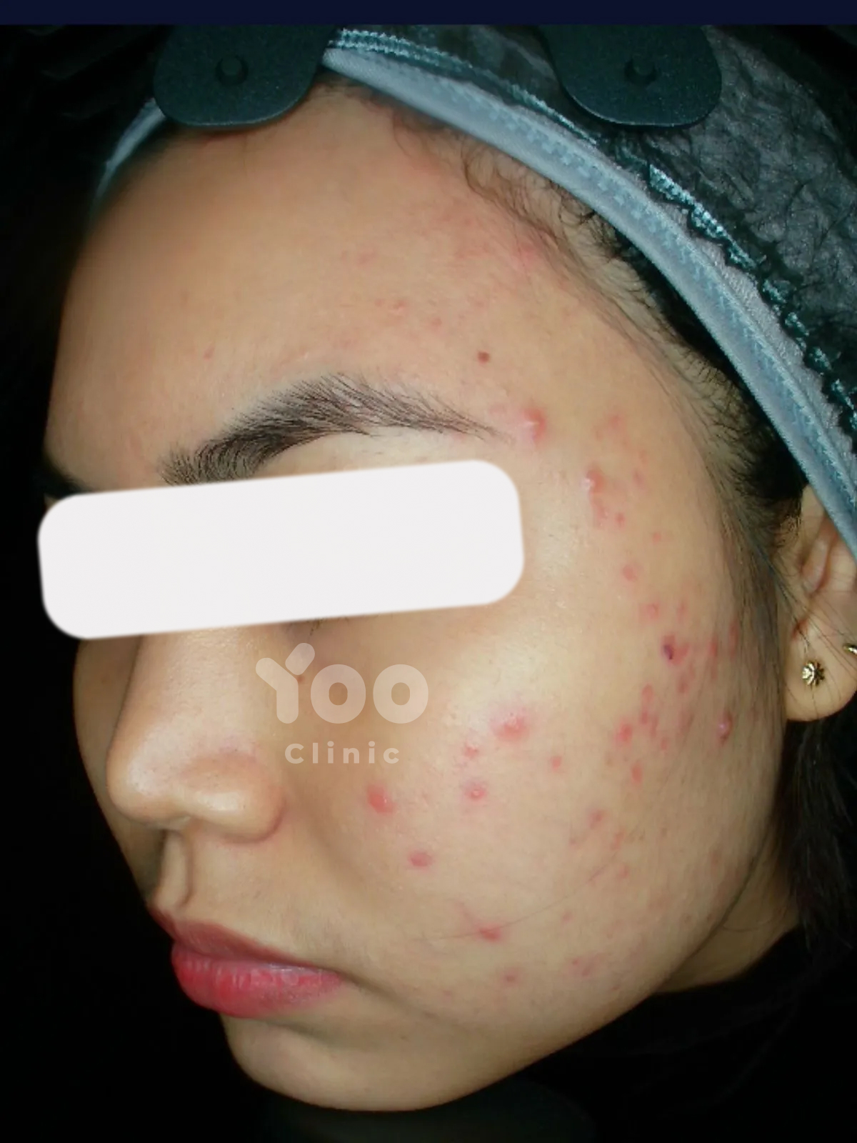 Acne Protocol Renewal before