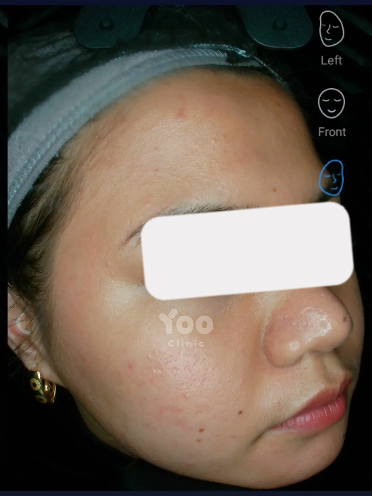 Acne Protocol Skin Clarity after