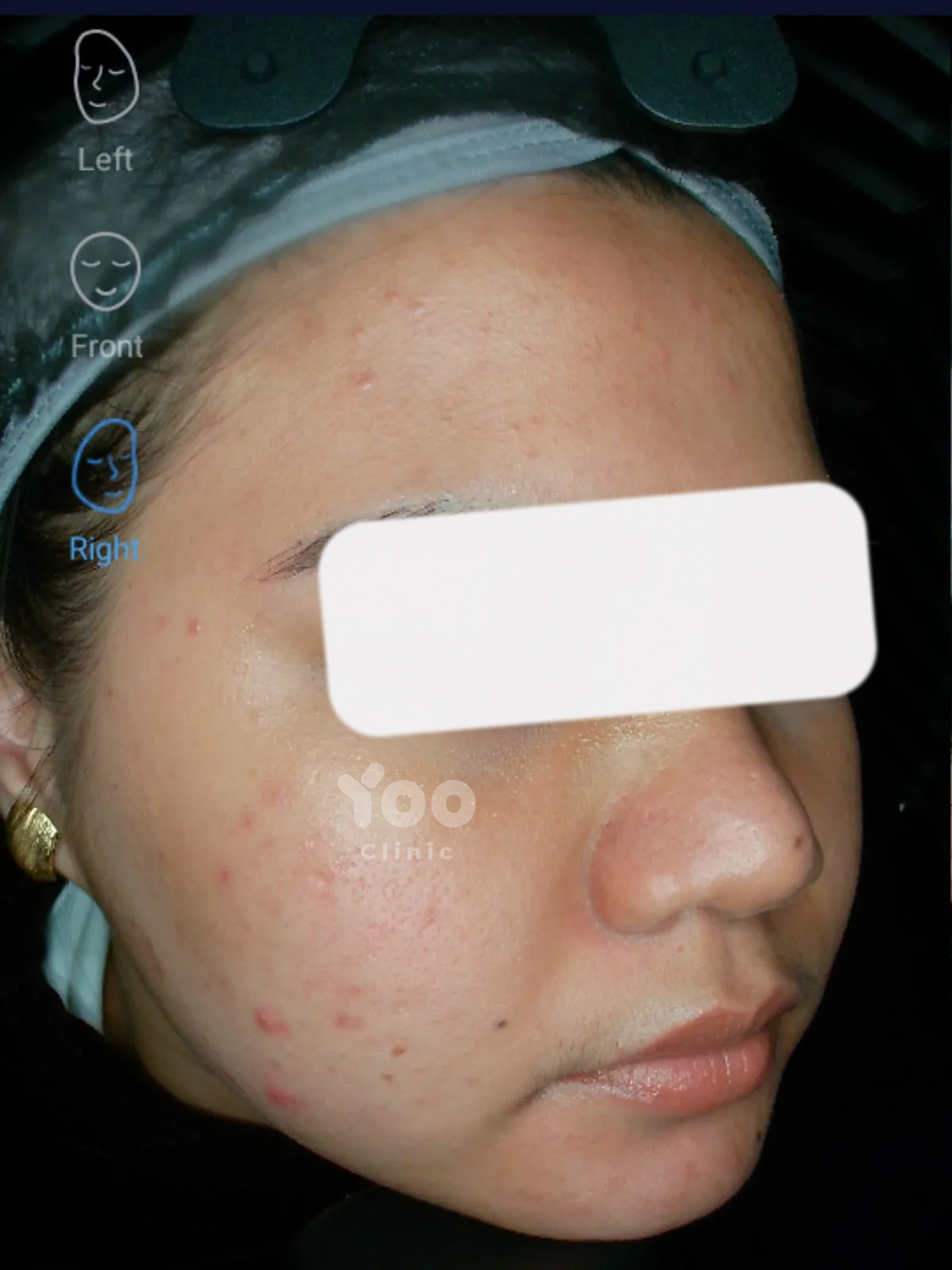 Acne Protocol Skin Clarity before