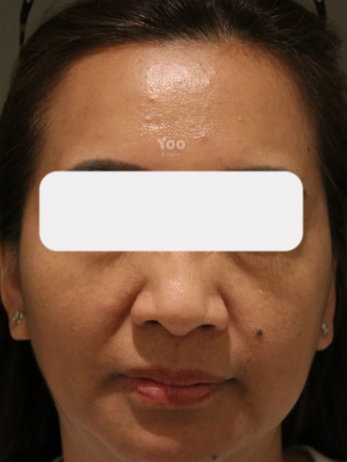 Glabella Wrinkle Treatment for Softer Frown Lines after