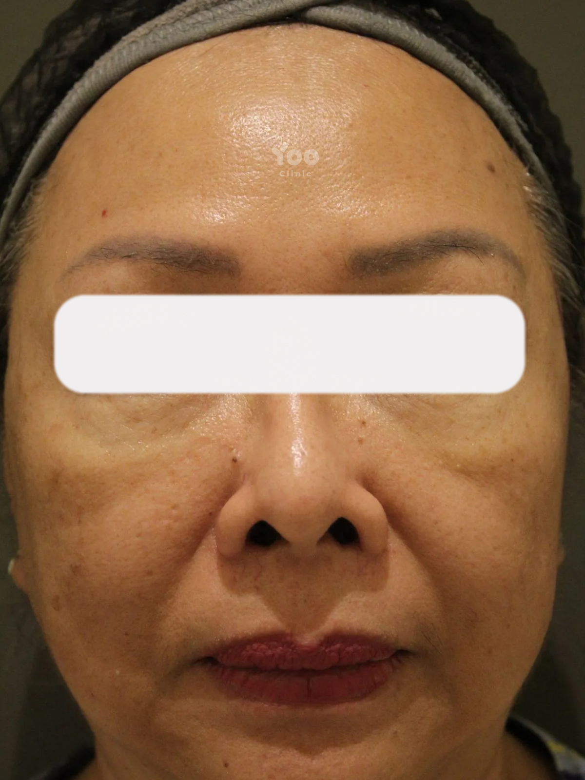Forehead Wrinkle Treatment for Smoother-Looking Skin after