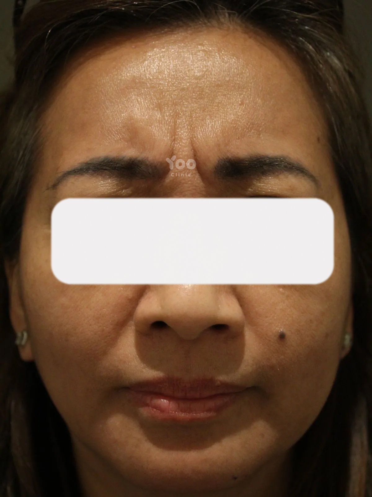 Glabella Wrinkle Treatment for Softer Frown Lines before