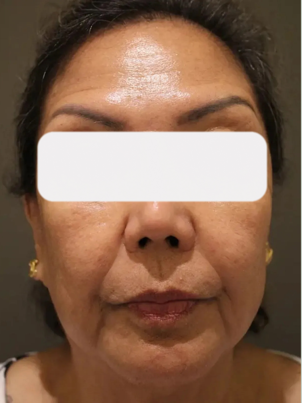 Forehead Wrinkle Treatment for Deep Horizontal Lines after