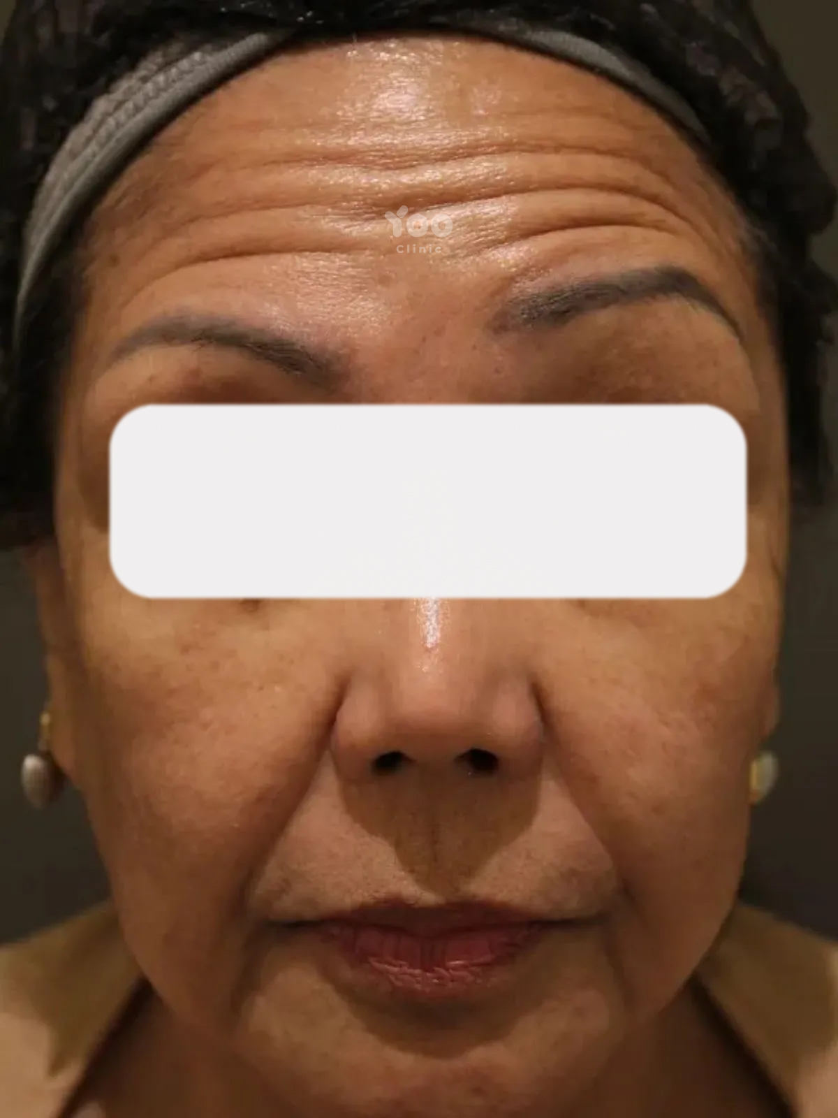 Forehead Wrinkle Treatment for Deep Horizontal Lines before