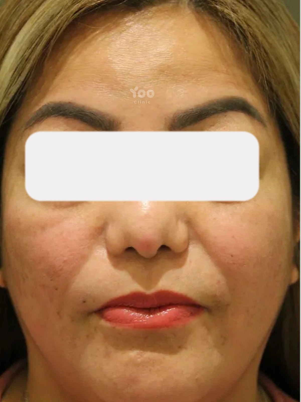 Forehead Wrinkle Treatment for a Smoother Upper Face after