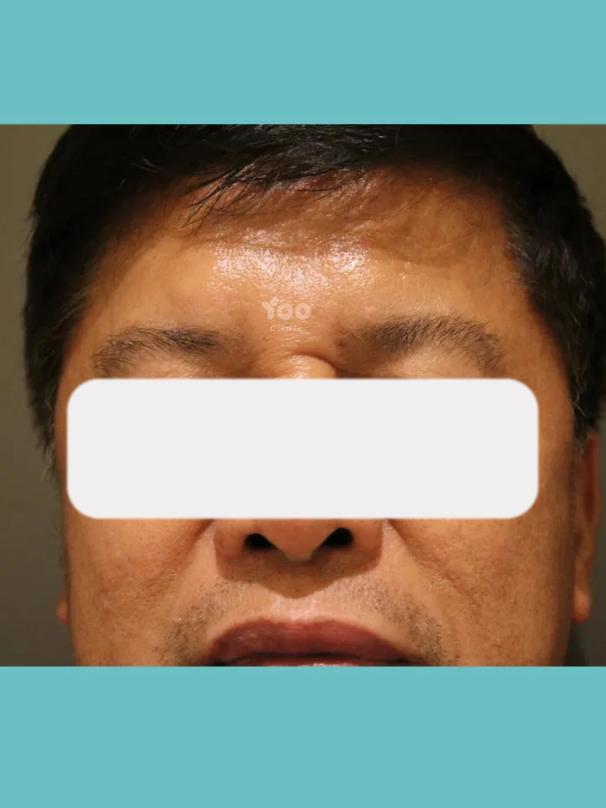 Glabella Wrinkle Treatment for Softer Frown Lines after