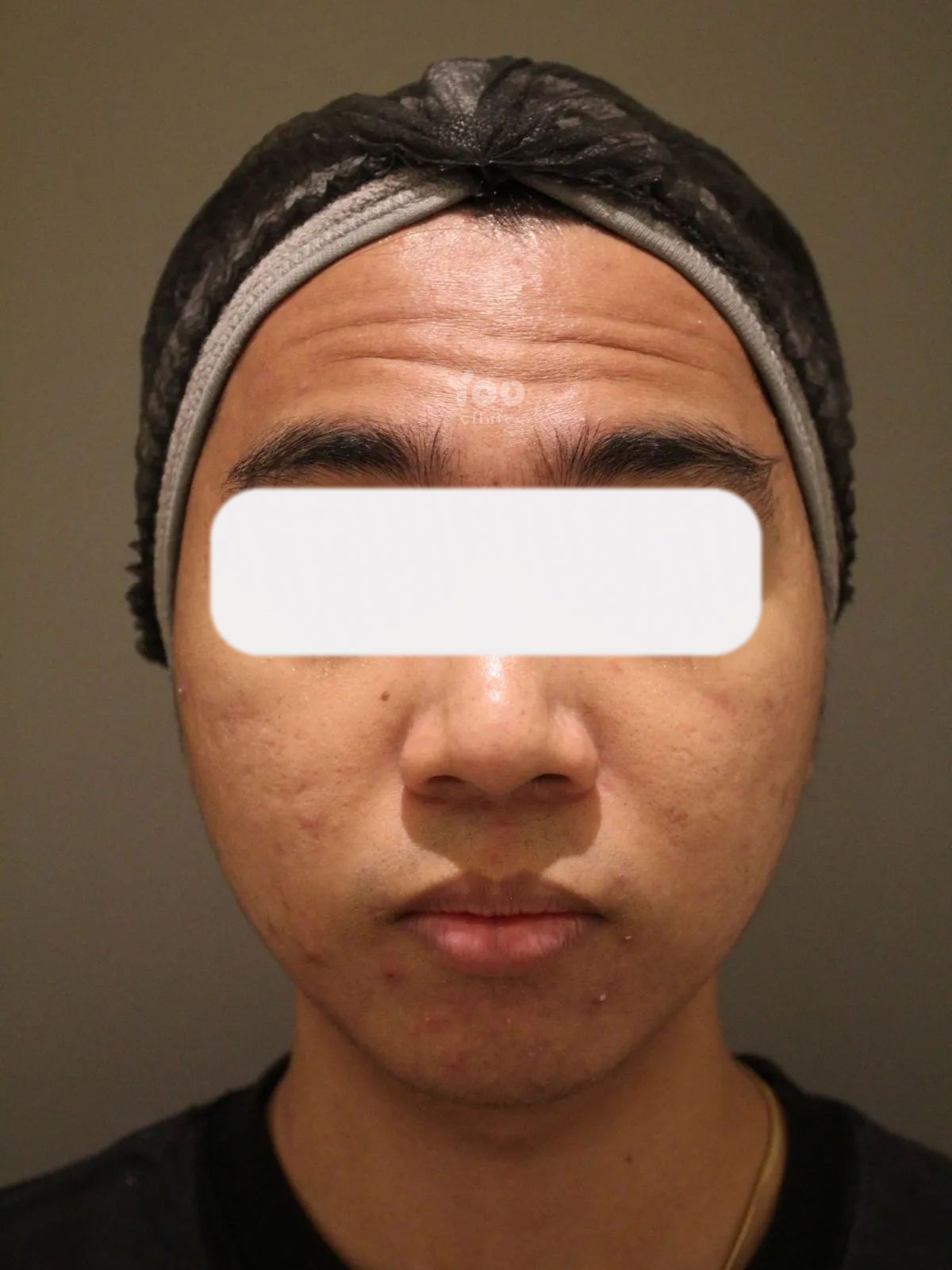 Forehead Wrinkle Treatment for Expression Lines before