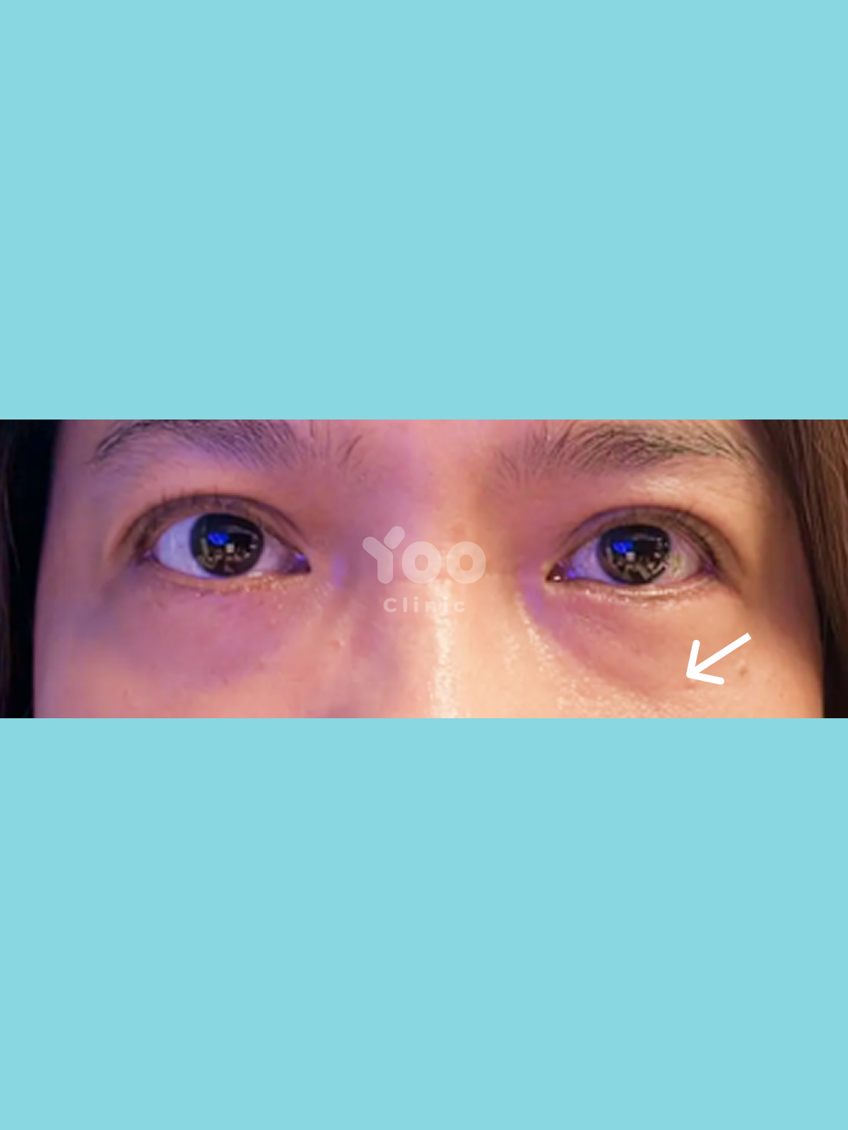 Lower Blepharoplasty for Under-Eye Bags after