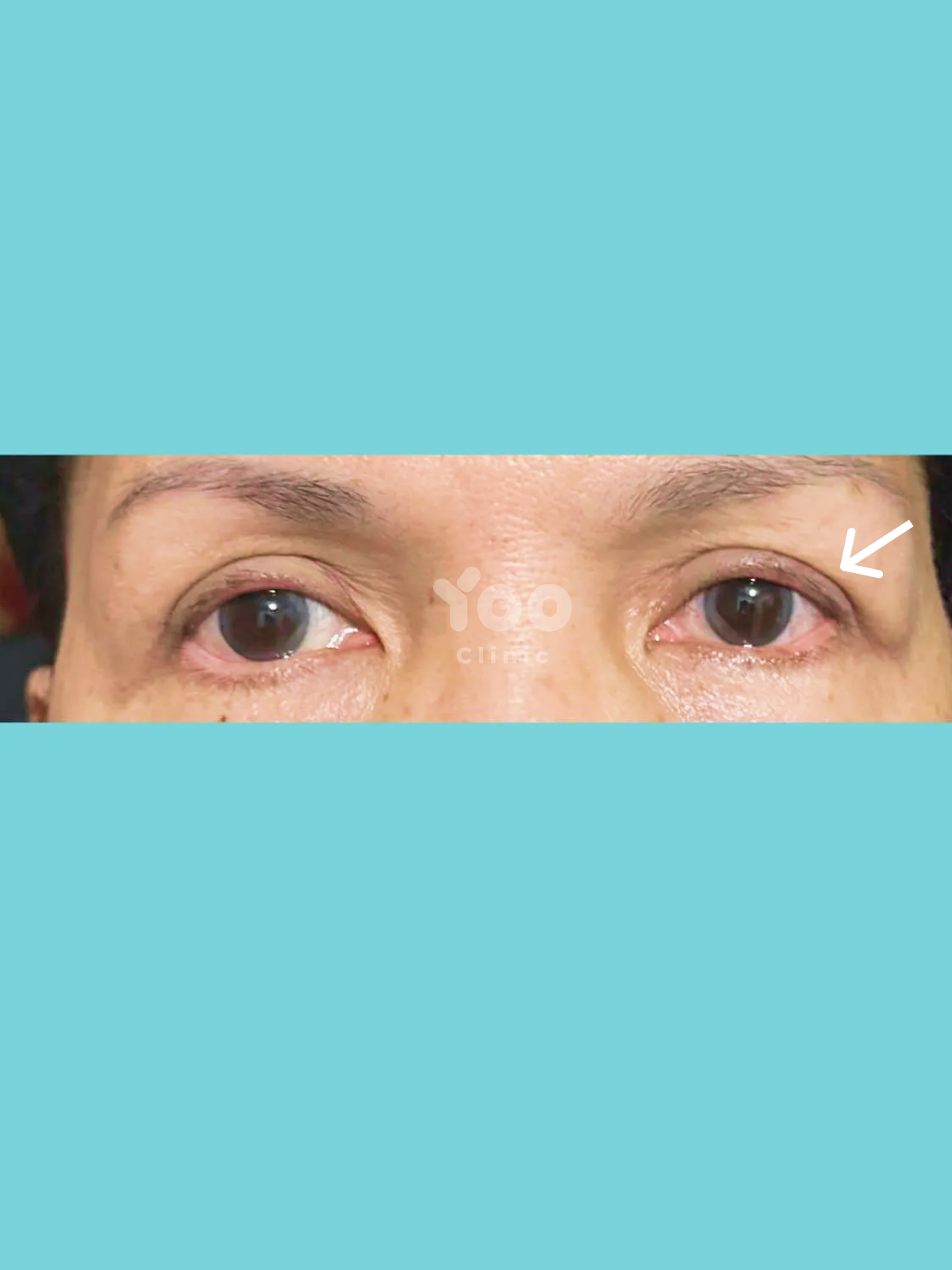 Upper Blepharoplasty for Drooping Eyelids after