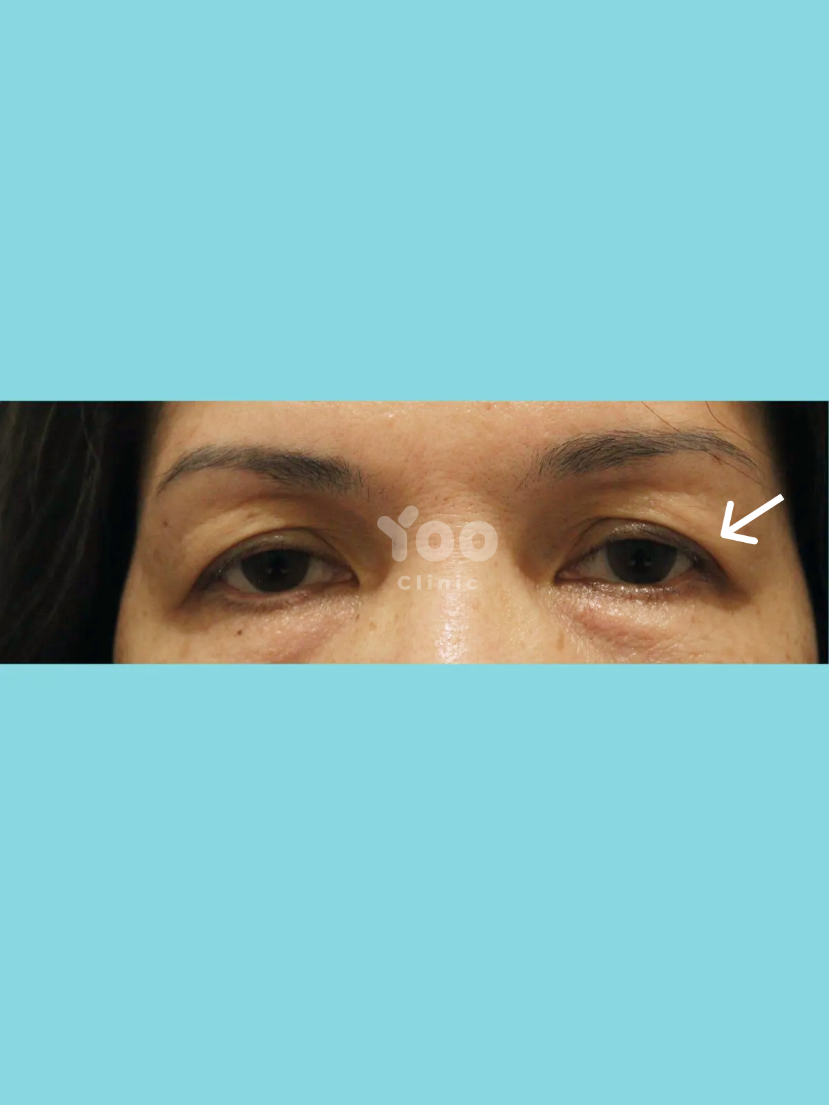 Upper Blepharoplasty for Drooping Eyelids before