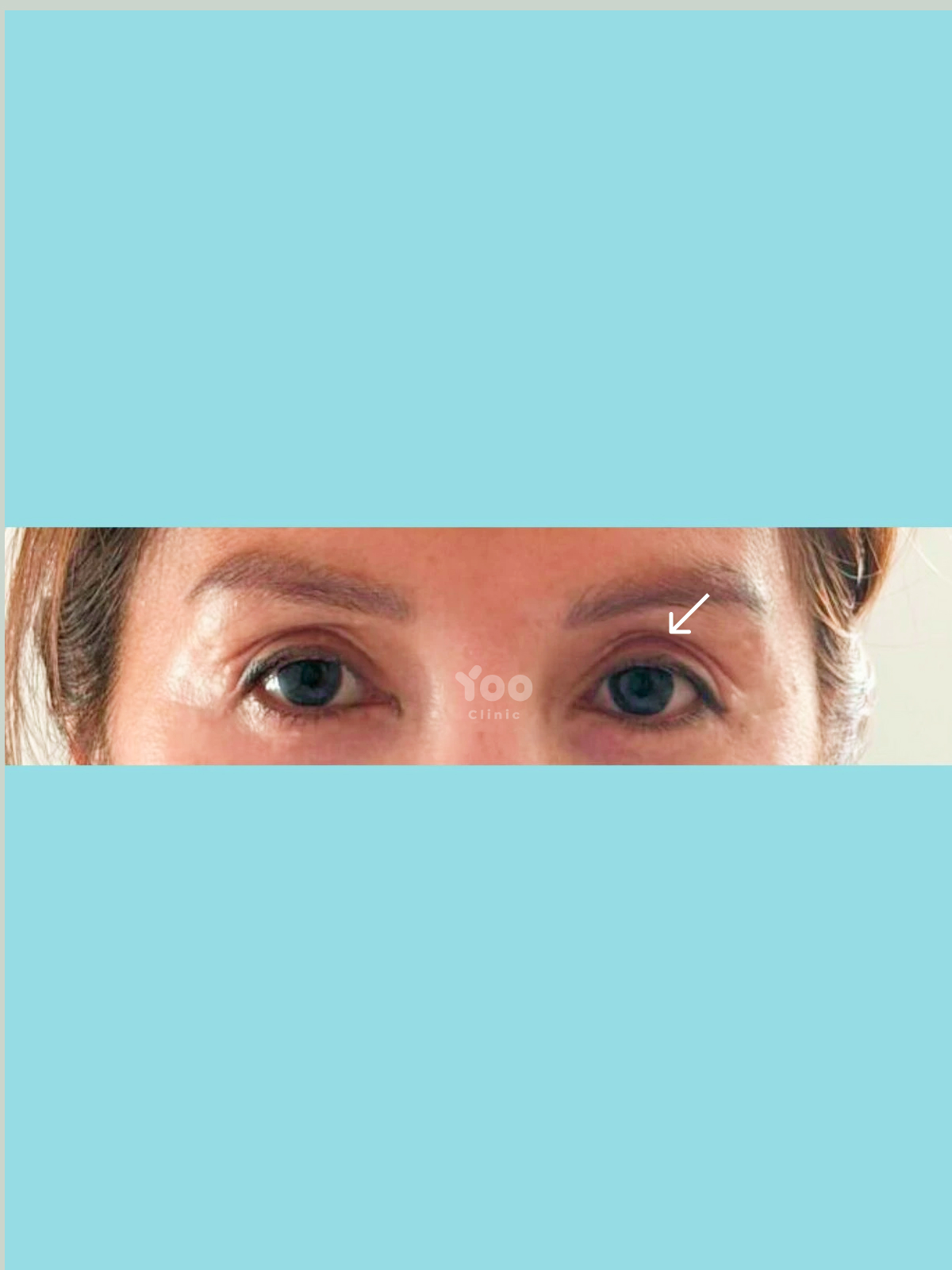 Upper Blepharoplasty for Subtle Eyelid Skin Excess after