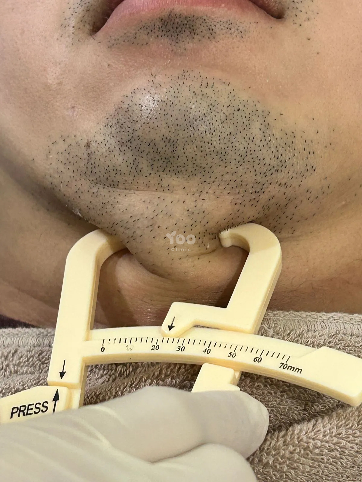 Mesolipo for Under-Chin Fat Reduction before