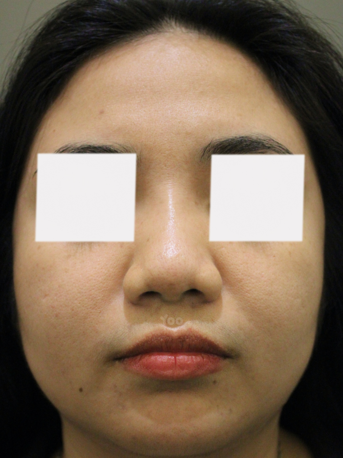 Subtle HIKO Nose Lift with Minimal Thread Count after