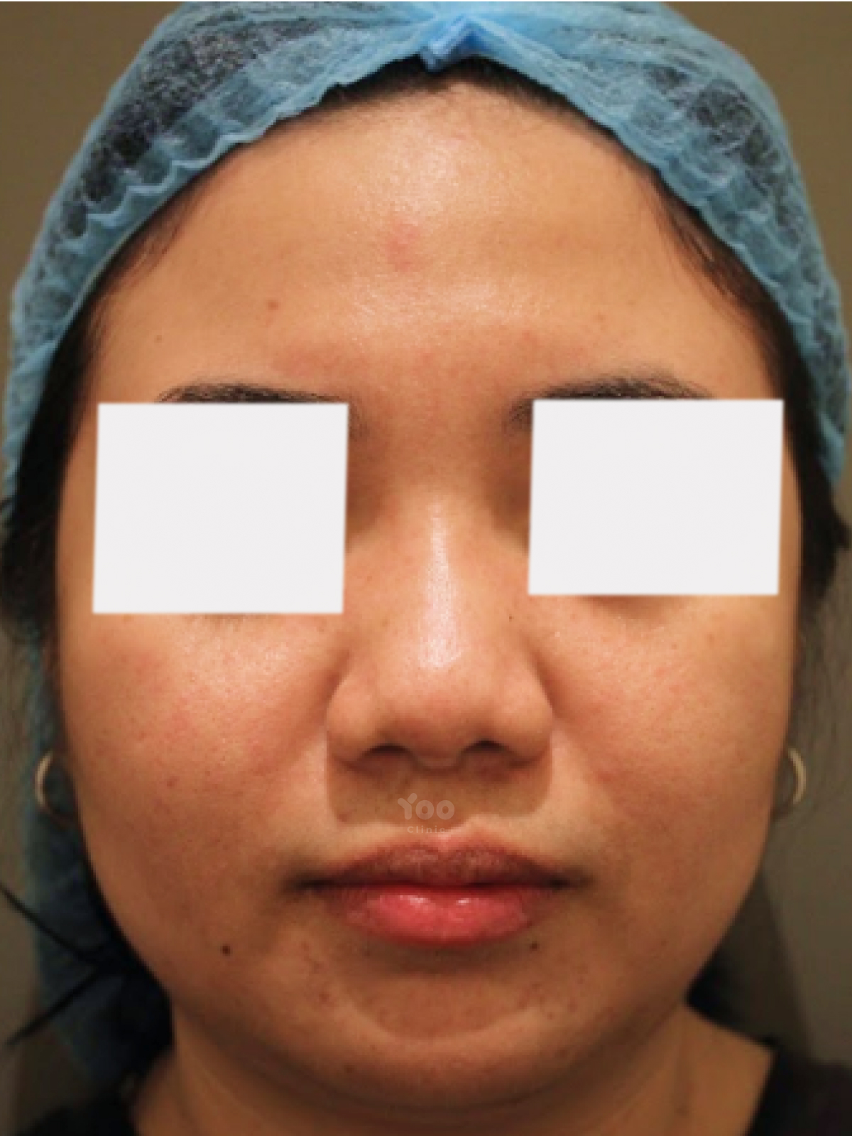 Subtle HIKO Nose Lift with Minimal Thread Count before