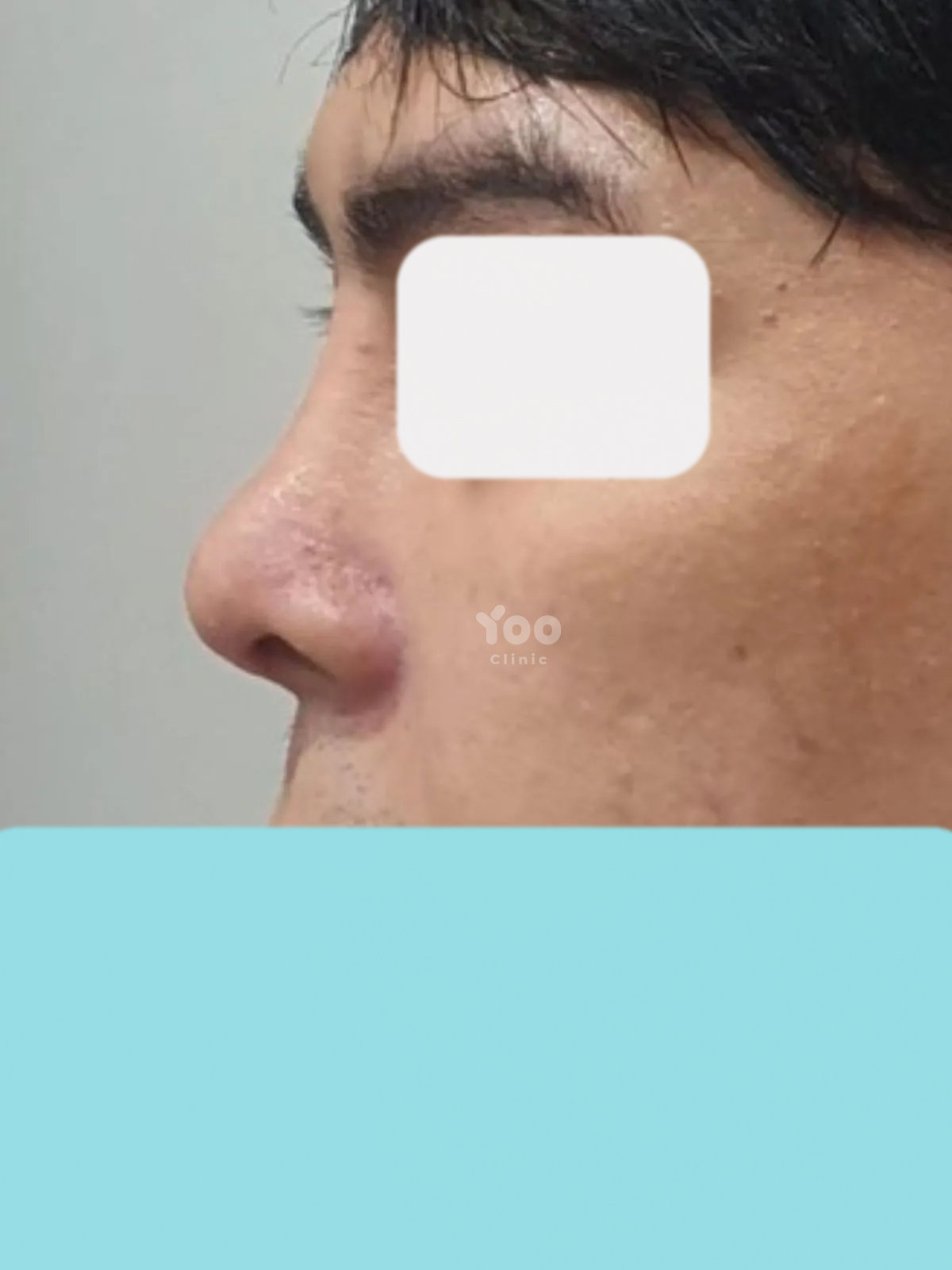 Rhinoplasty for a More Balanced Side Profile after
