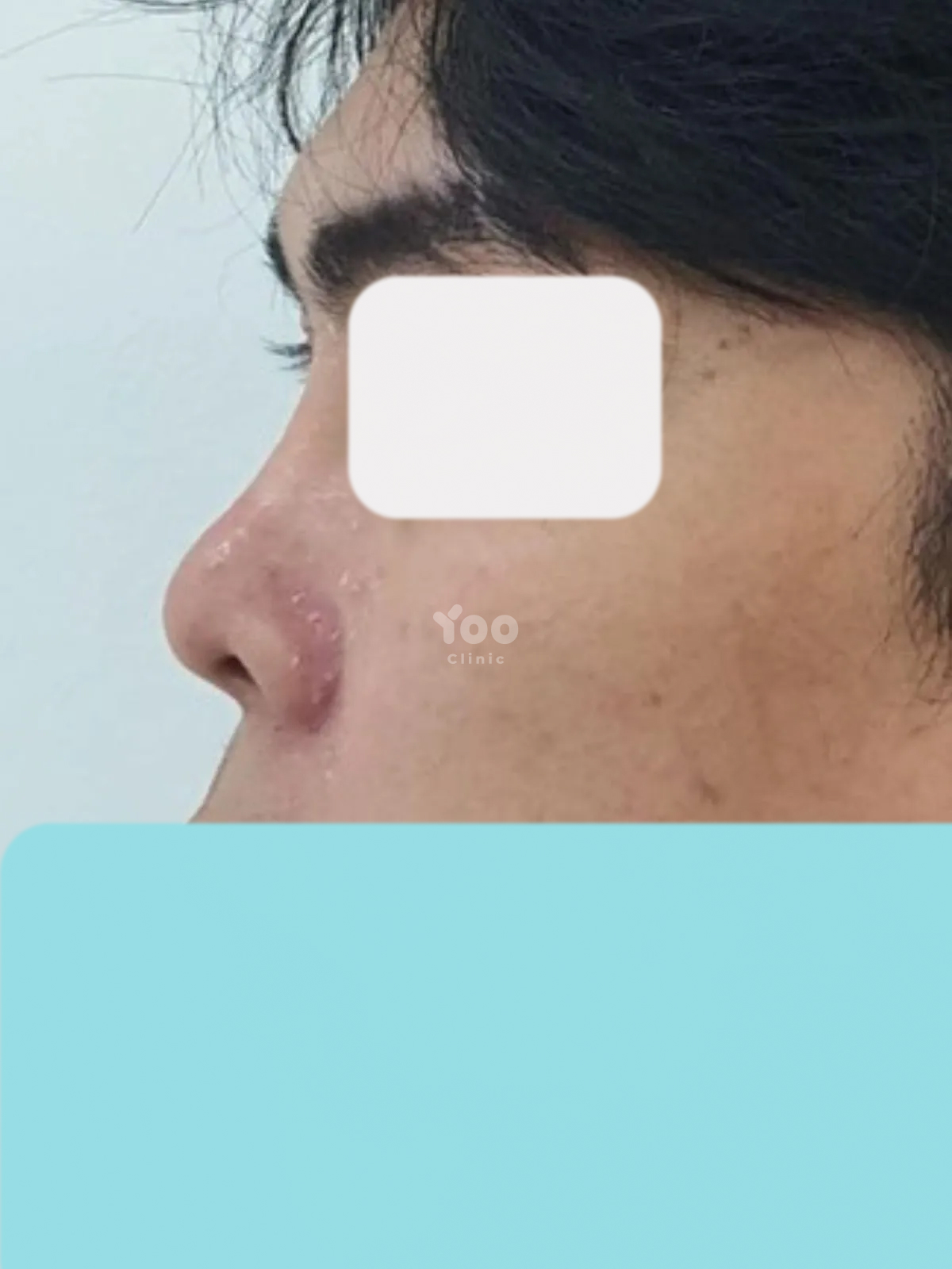 Rhinoplasty for a More Balanced Side Profile before
