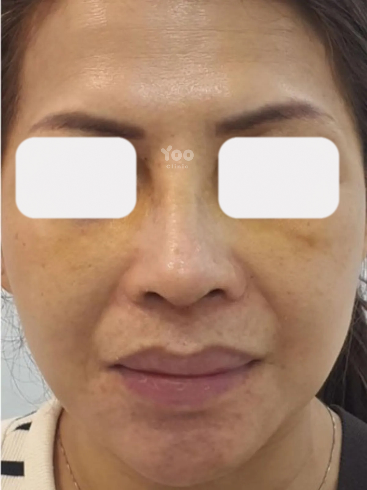 Rhinoplasty for Better Nasal Definition from the Front View after