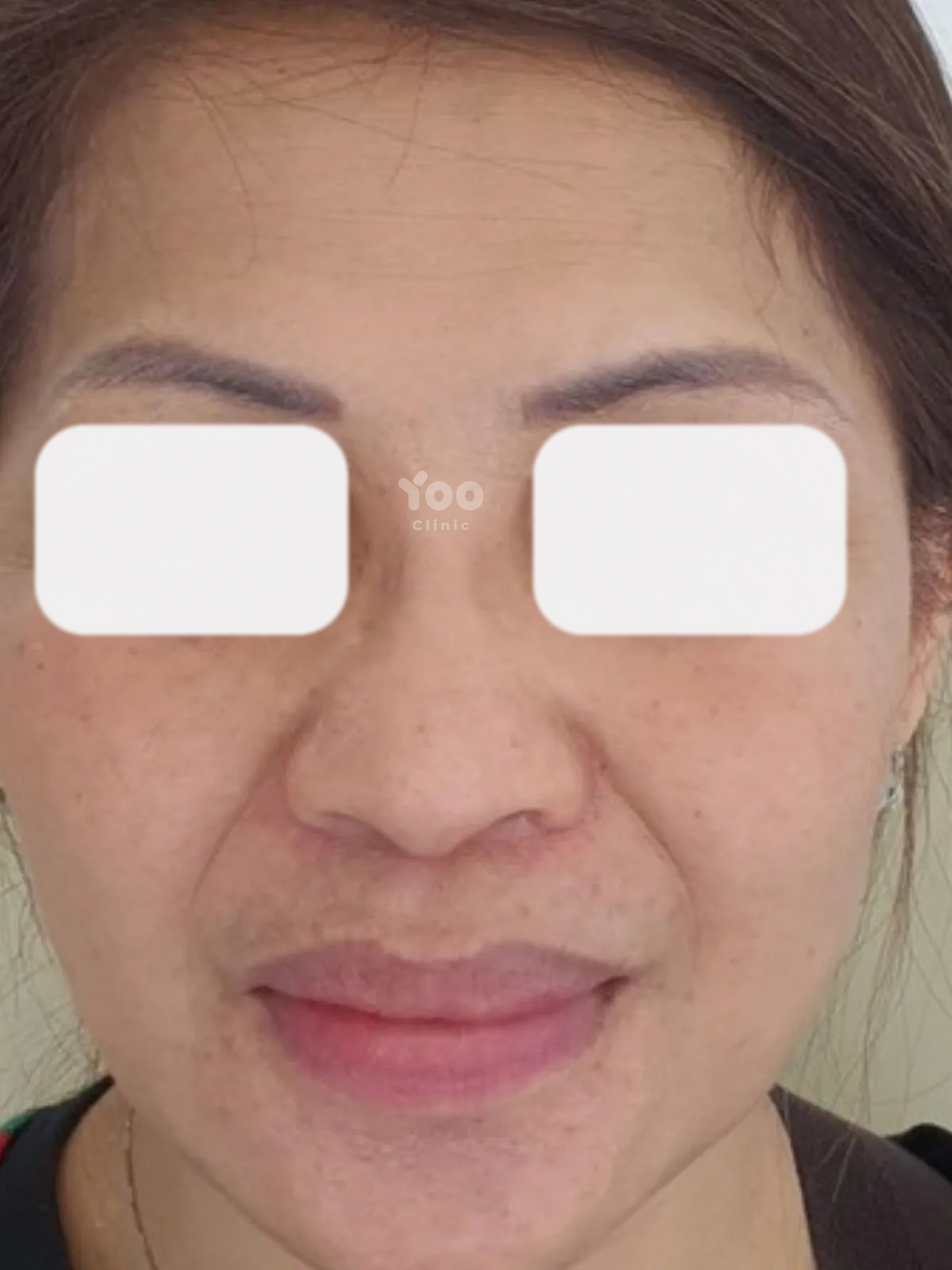 Rhinoplasty for Better Nasal Definition from the Front View before