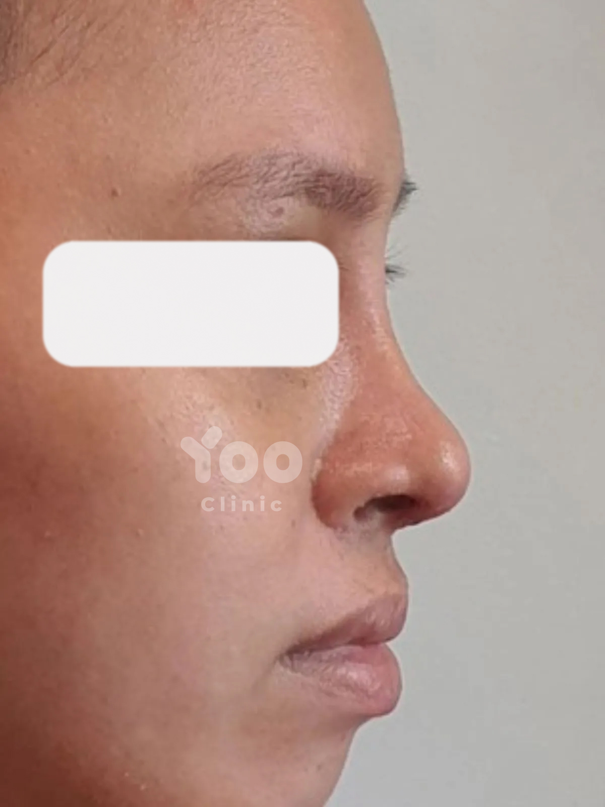Rhinoplasty for Improved Bridge Height and Side Profile after