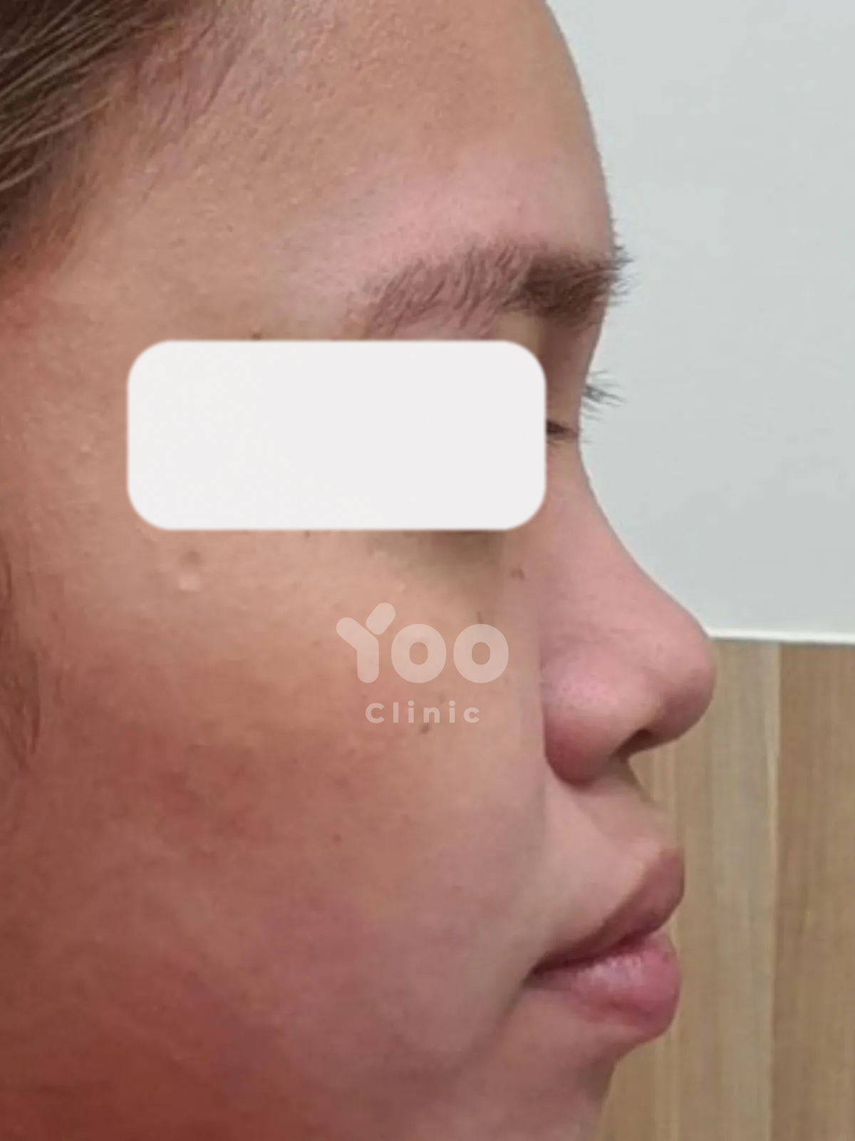 Rhinoplasty for Improved Bridge Height and Side Profile before