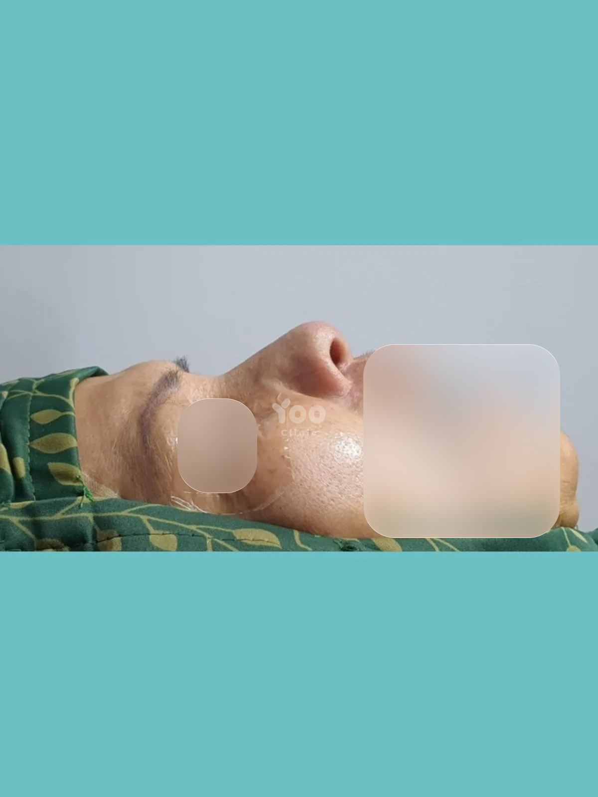 Rhinoplasty for Nasal Tip and Base Refinement before