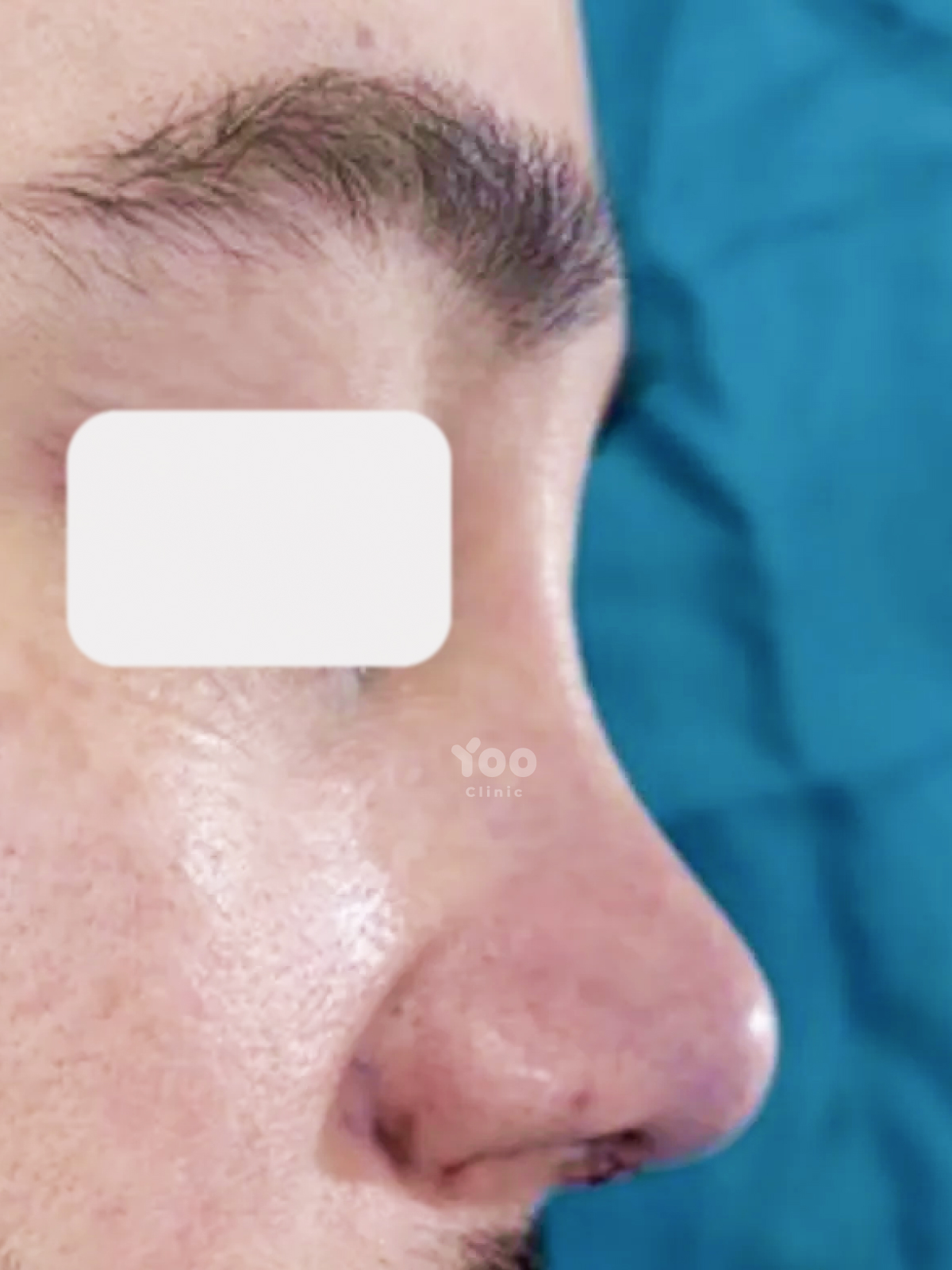 Rhinoplasty for Stronger Bridge and Tip Projection after