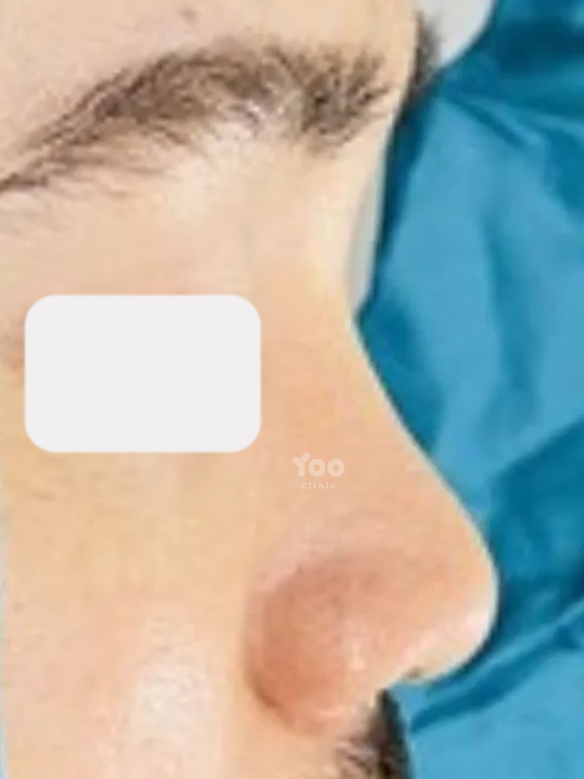 Rhinoplasty for Stronger Bridge and Tip Projection before