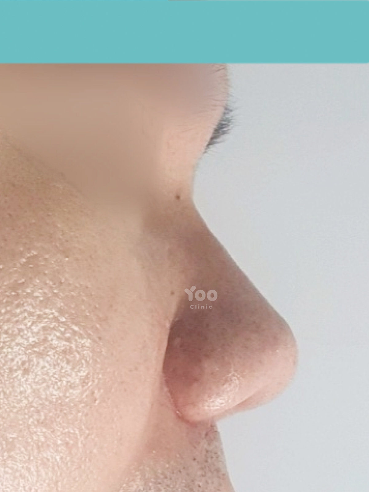 Rhinoplasty for Early Bridge and Tip Refinement before