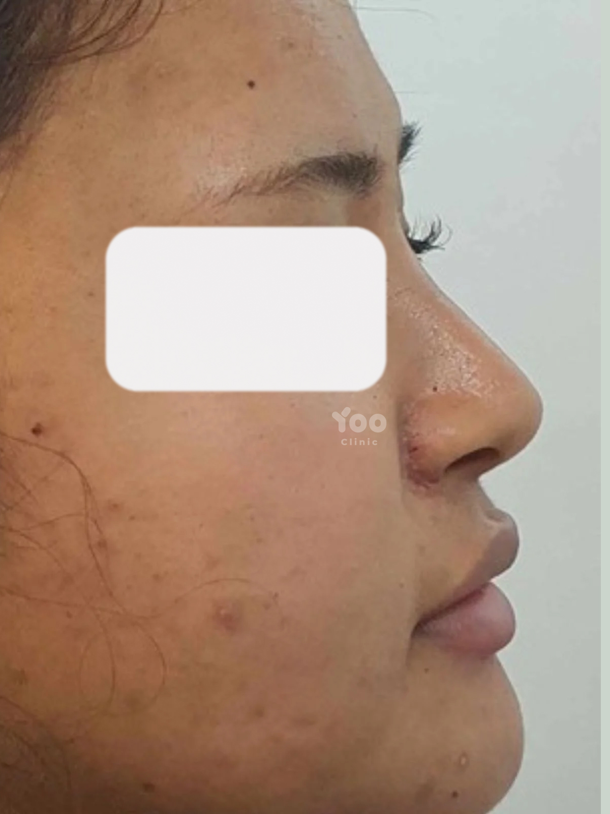 Alarplasty for Reduced Alar Flaring after