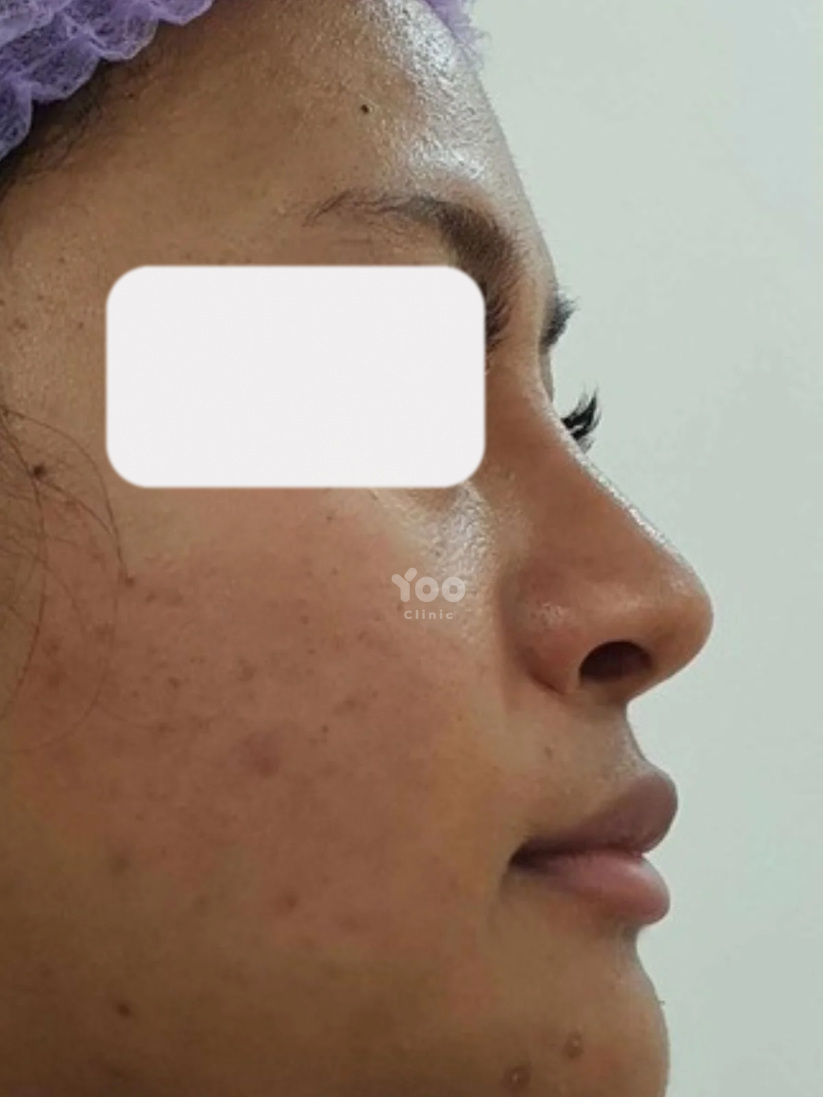 Alarplasty for Reduced Alar Flaring before
