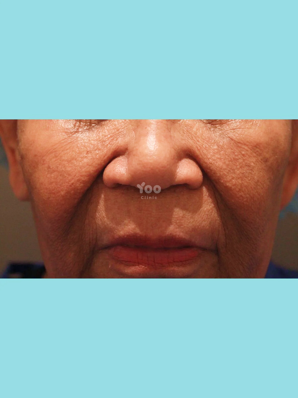 Alarplasty for a More Refined Nasal Base before