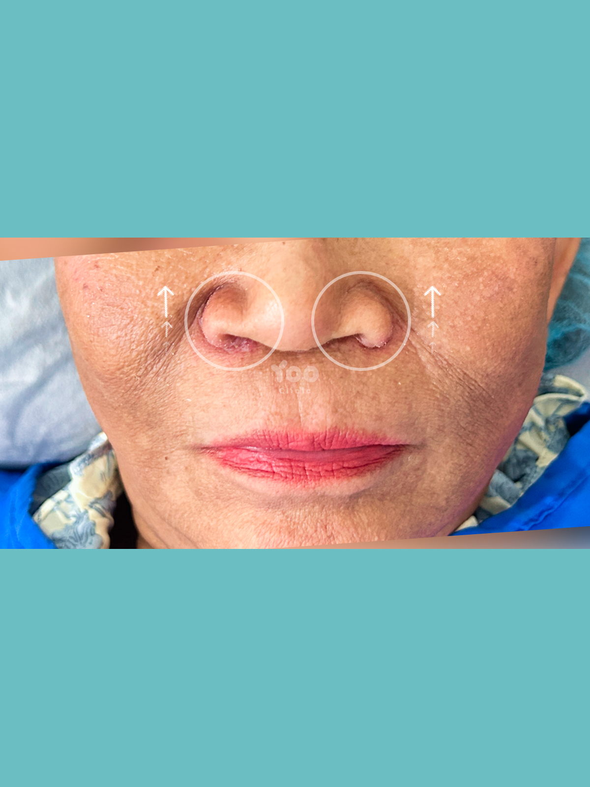 Alarplasty for a More Refined Nasal Base after