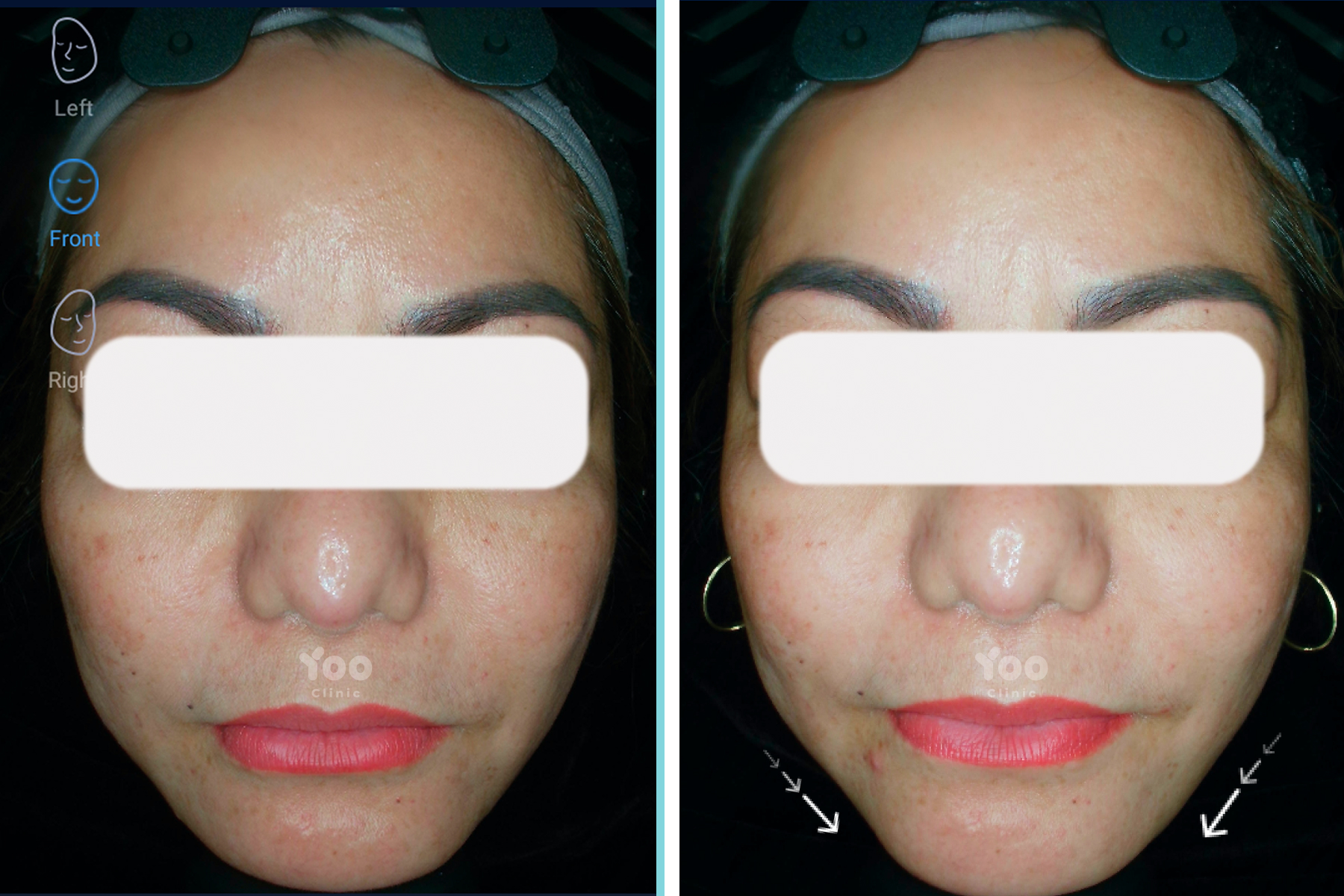 Jawtox for a More Tapered Face Shape - case preview
