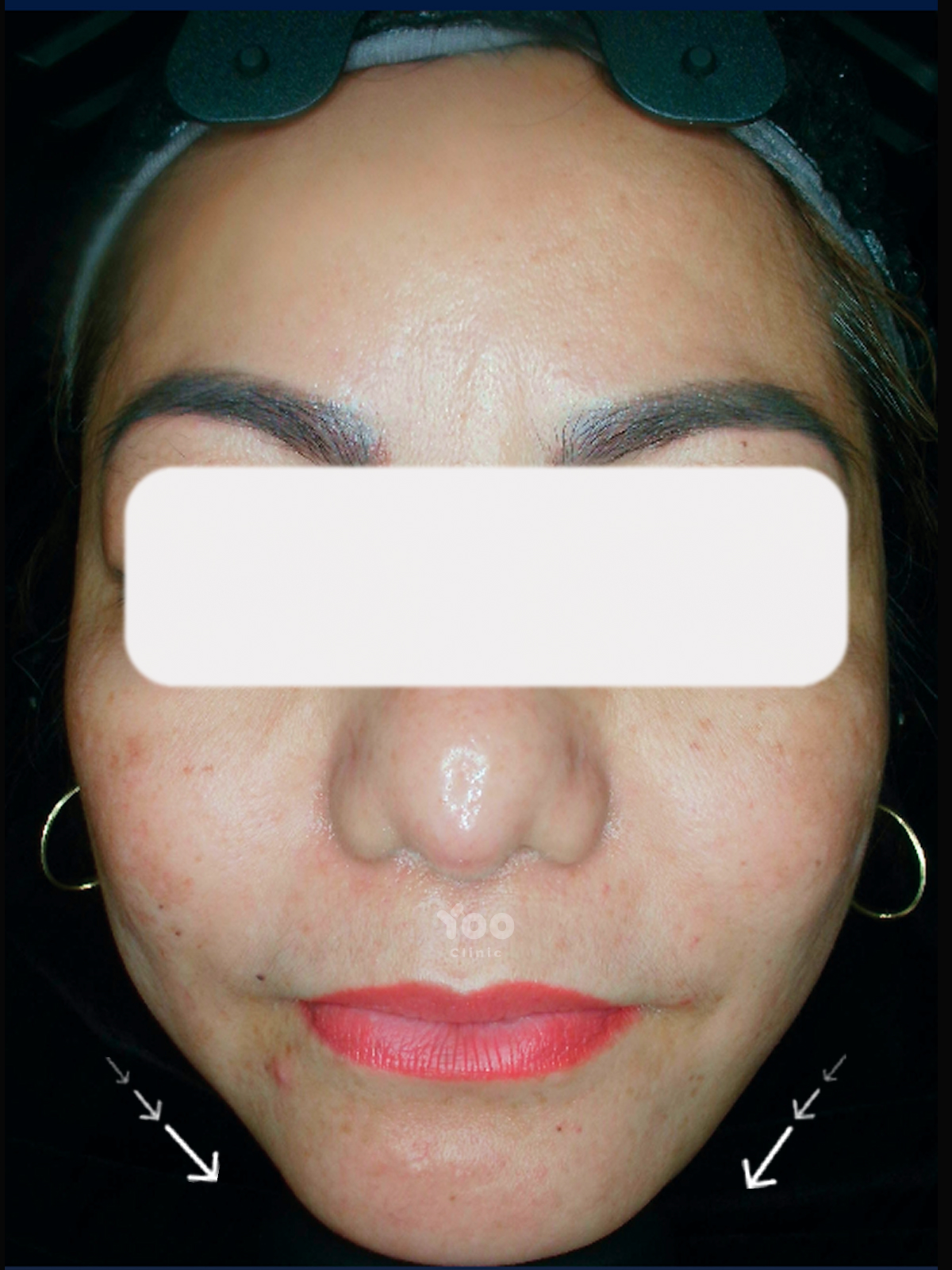 Jawtox for a More Tapered Face Shape after