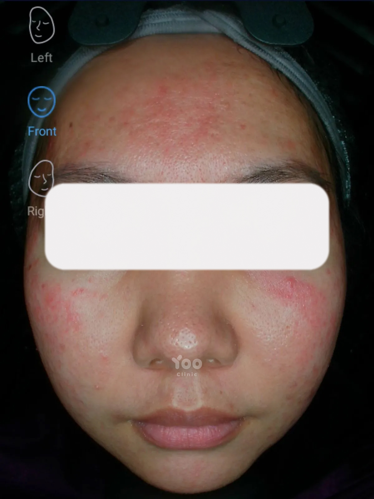 Masseter Contouring for a Slimmer Lower Face before