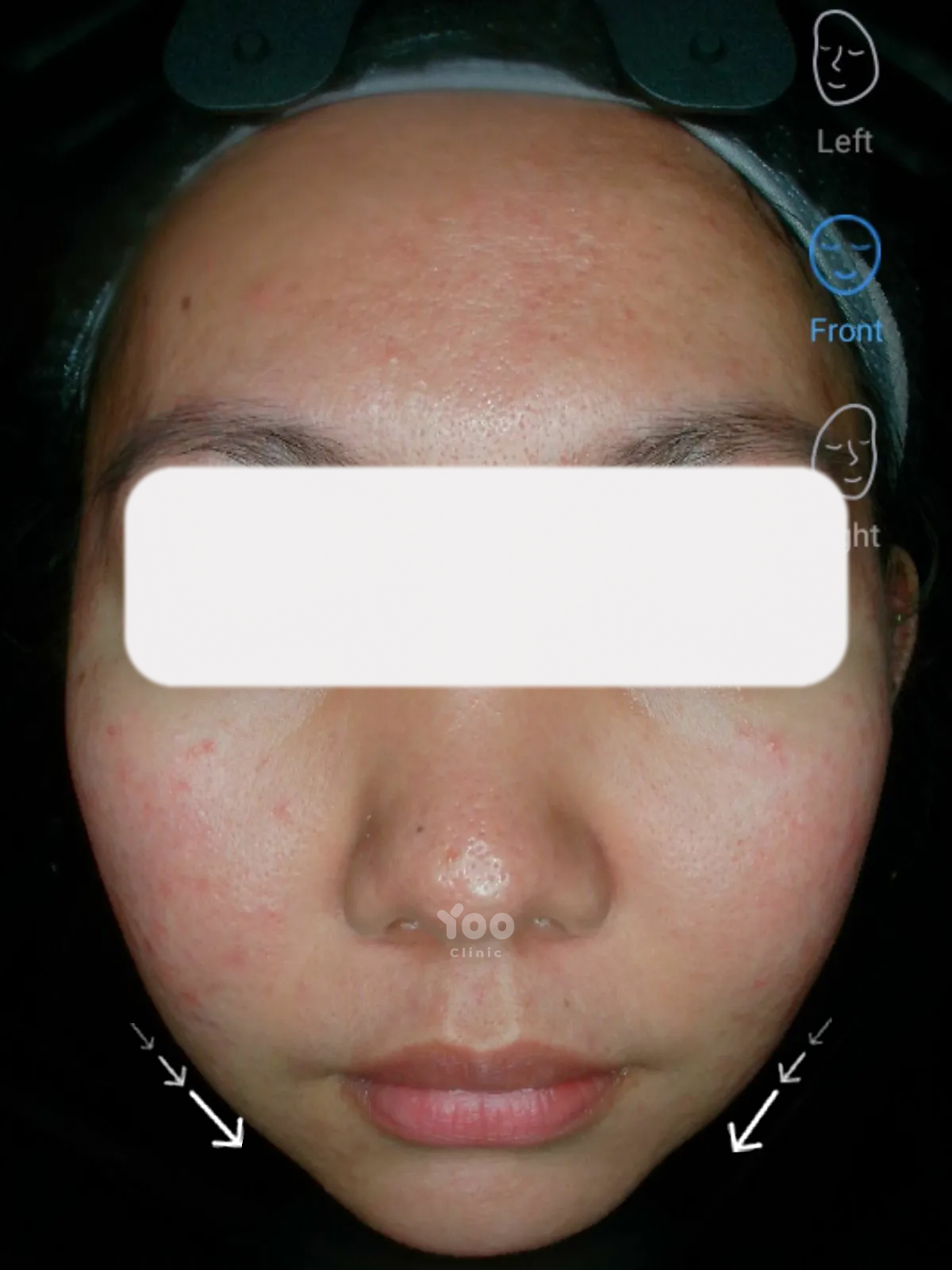 Masseter Contouring for a Slimmer Lower Face after
