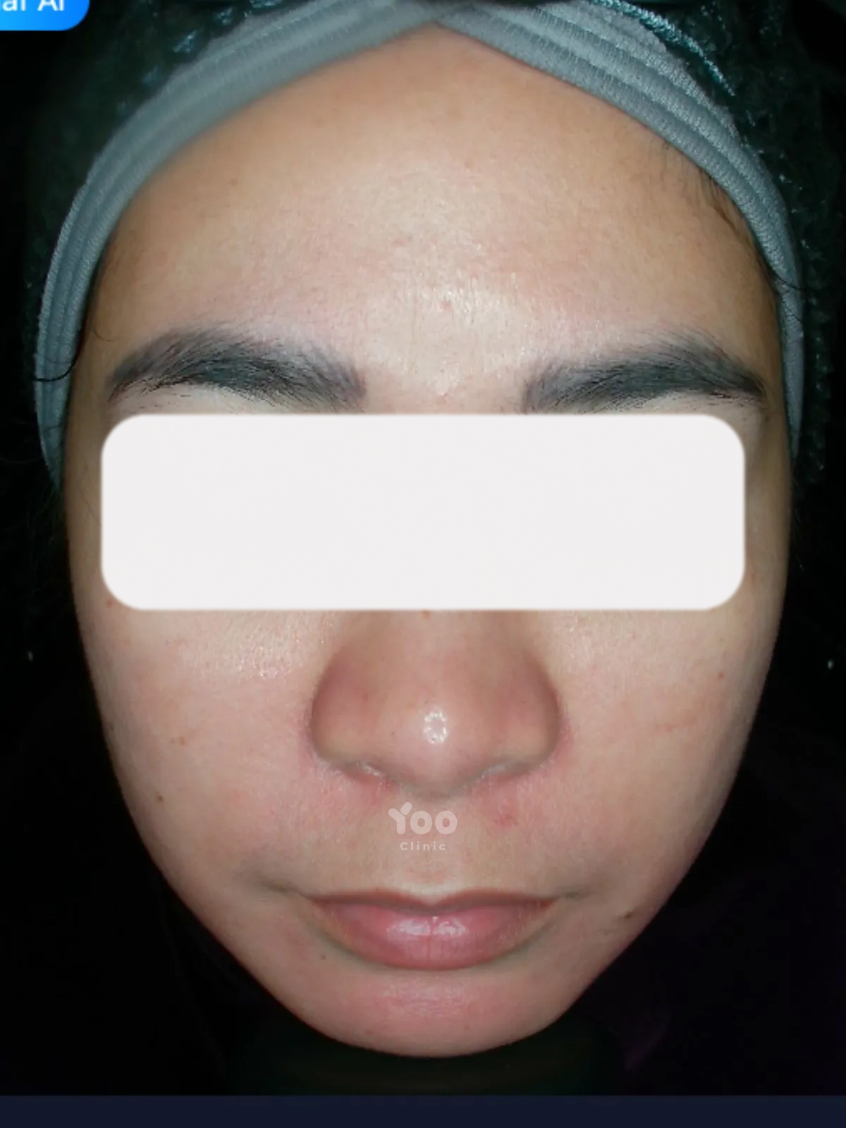 Jawtox for a Softer Jawline Contour before