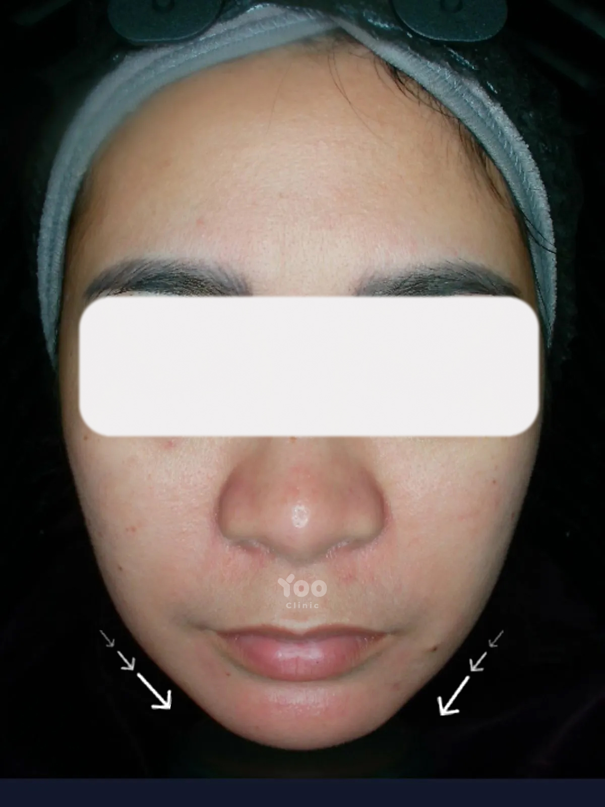 Jawtox for a Softer Jawline Contour after