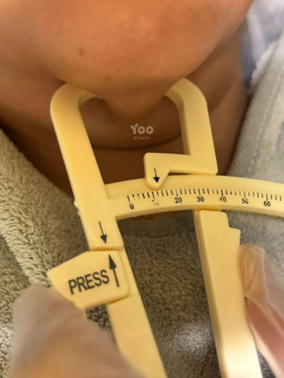 Mesolipo for Double Chin and Under-Chin Contour after