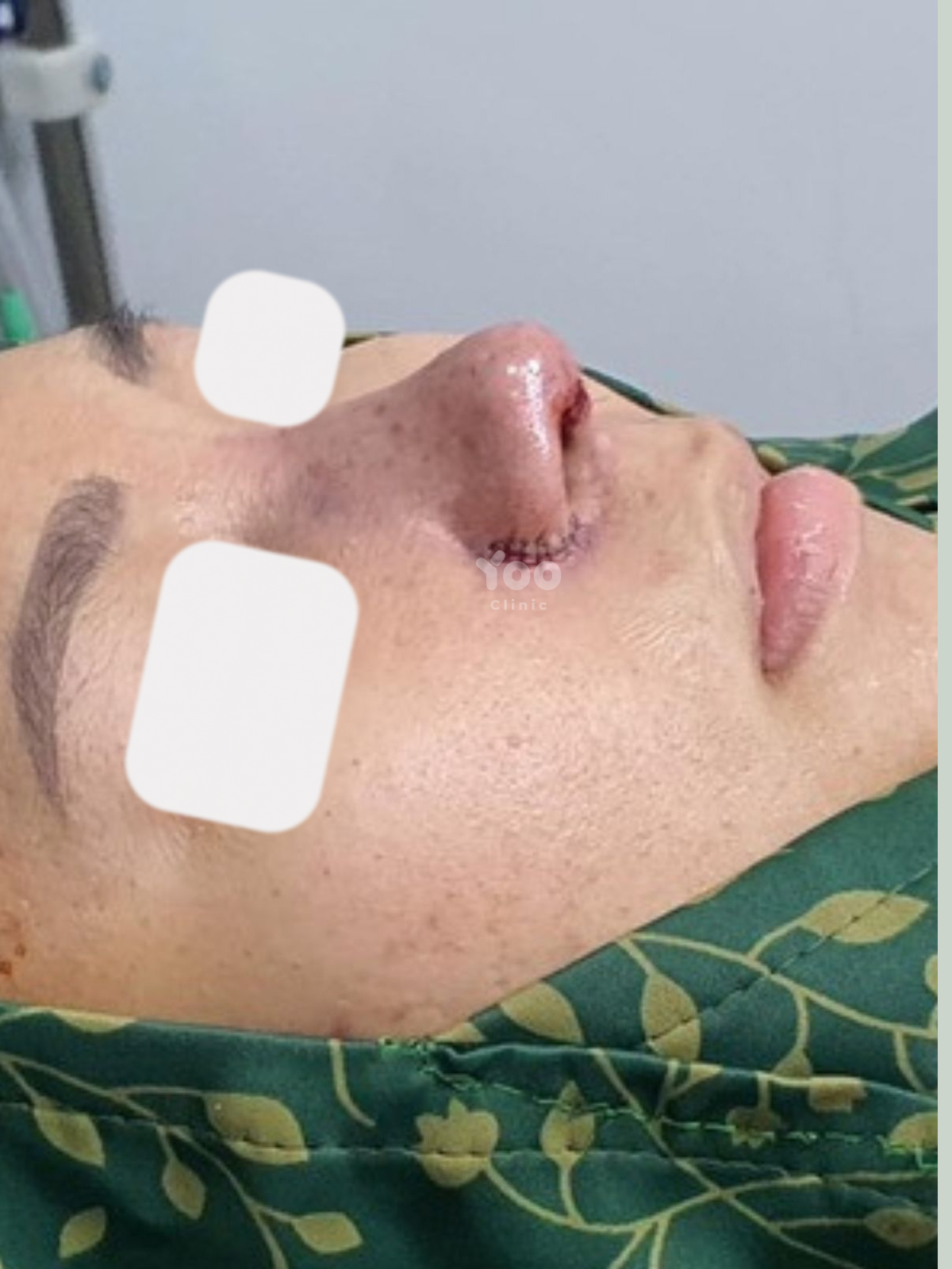 Rhinoplasty for Improved Bridge Height and Tip Support after