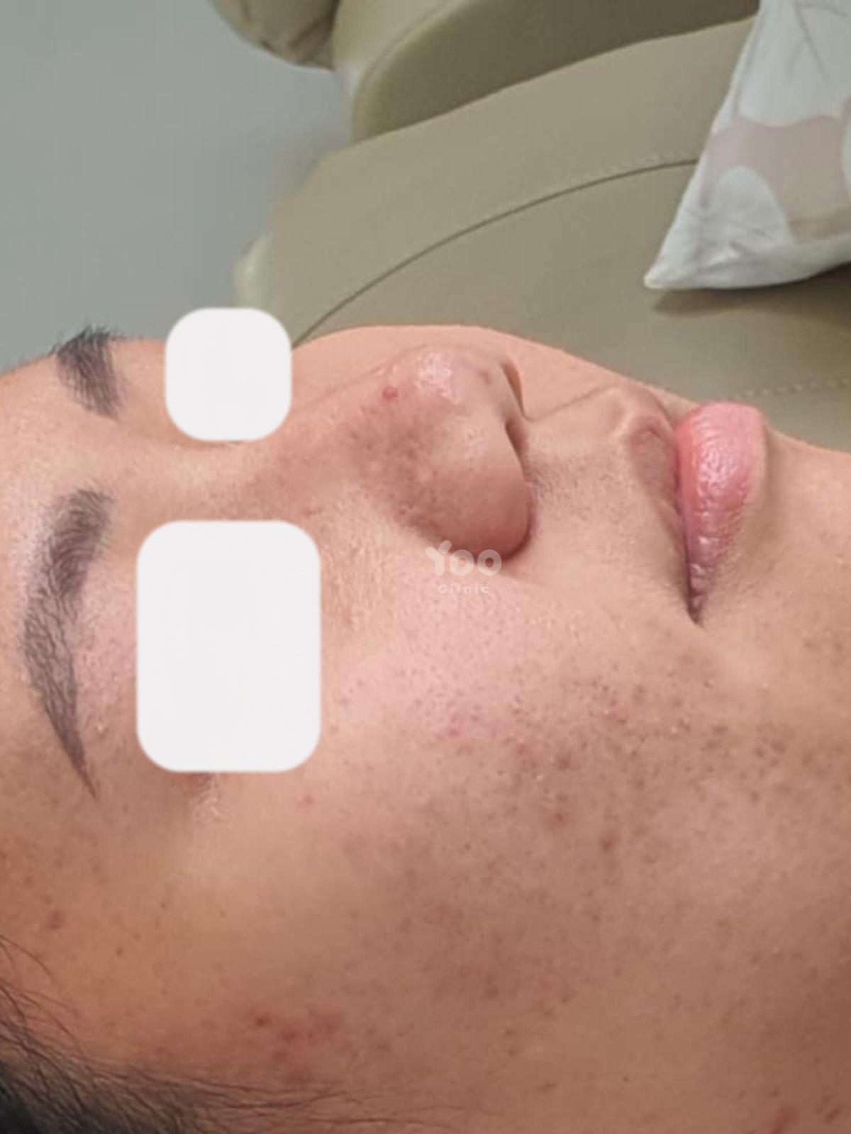 Rhinoplasty for Improved Bridge Height and Tip Support before