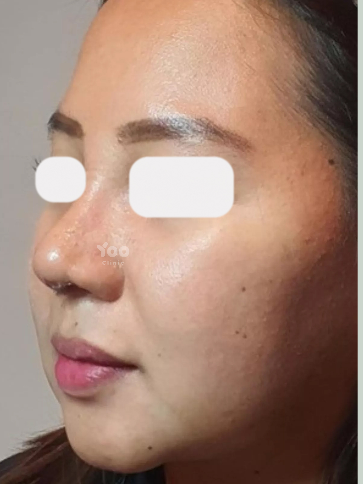 Rhinoplasty for Natural-Looking Nose Definition after