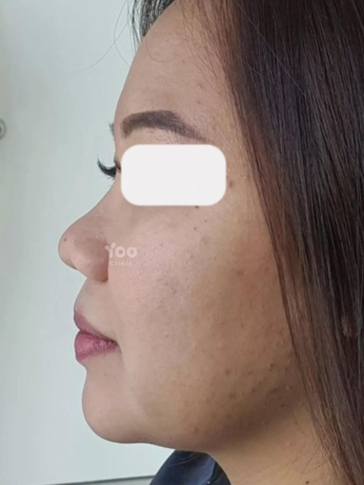 Rhinoplasty for Natural-Looking Nose Definition before