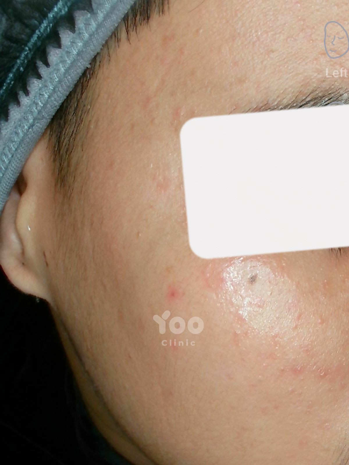 Acne Peel Protocol: Visible Improvement After Two Sessions after