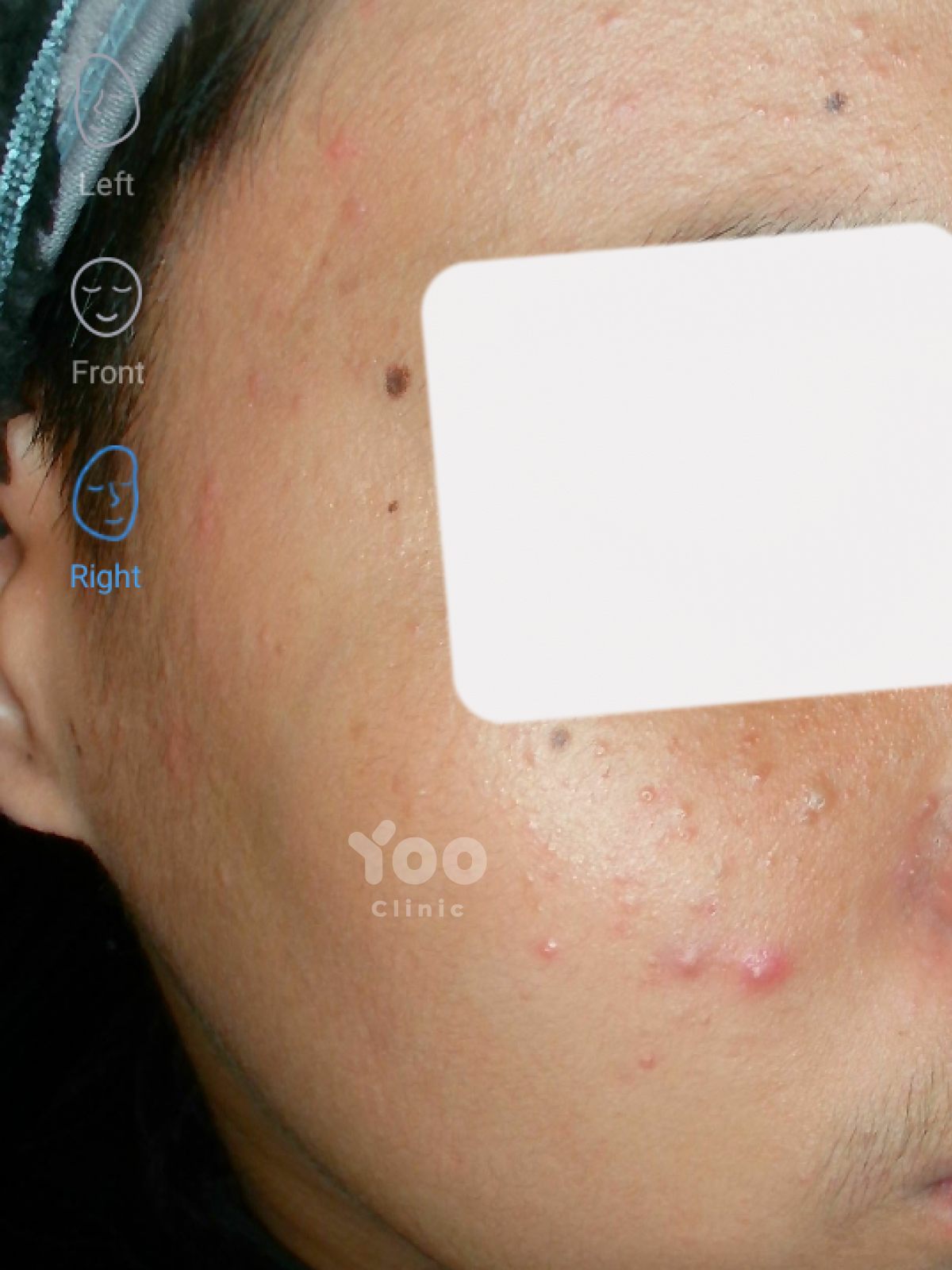 Acne Peel Protocol: Visible Improvement After Two Sessions before