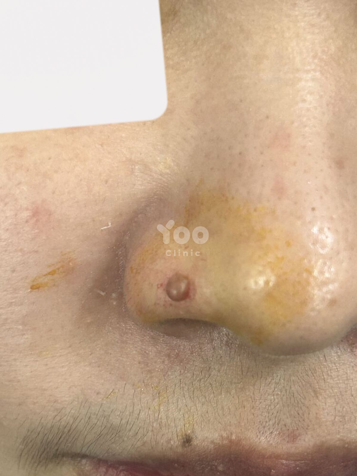 Nasal Mole Removal: Early Post-Procedure Result before