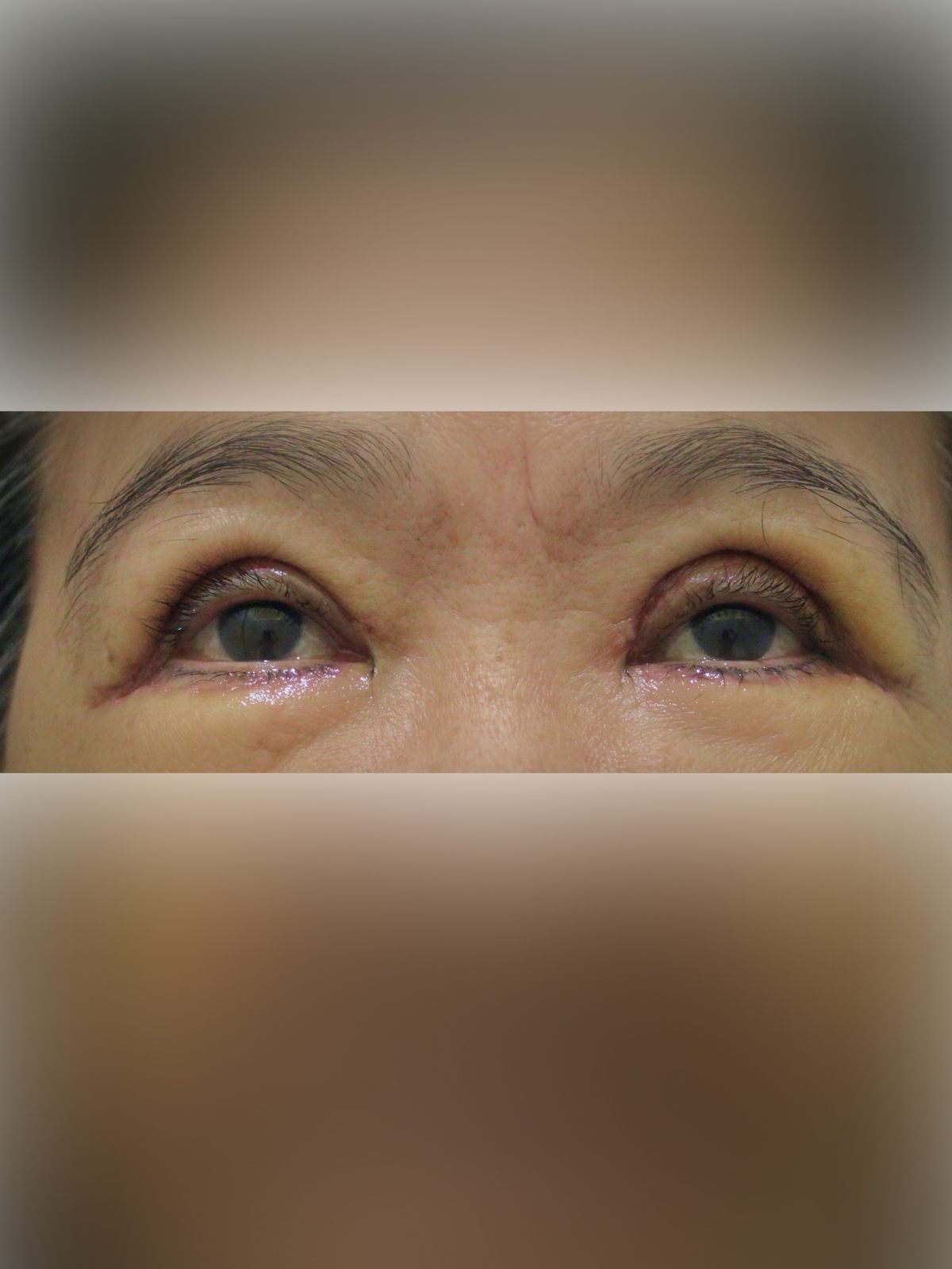 Upper Blepharoplasty: Front-View Early Healing after