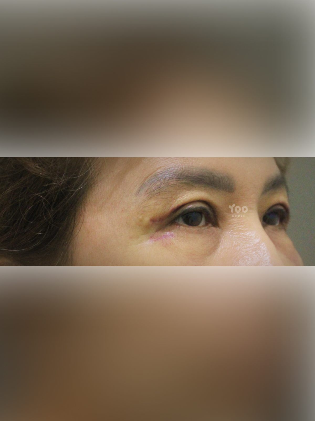 Upper Blepharoplasty: Side-View Eyelid Refinement after