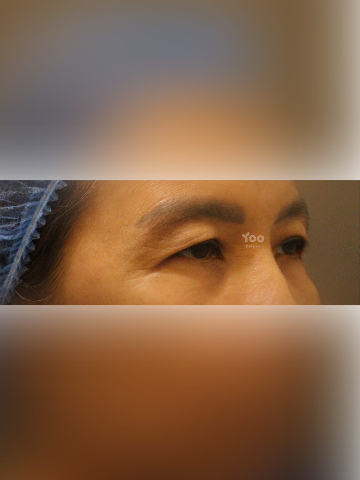 Upper Blepharoplasty: Side-View Eyelid Refinement before